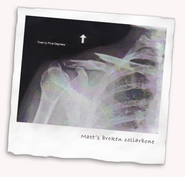 Matt's broken collarbone X-ray