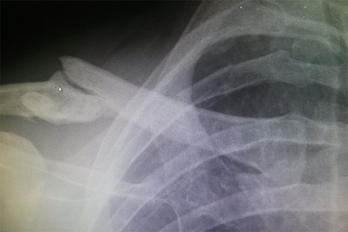 Matt's second broken collarbone