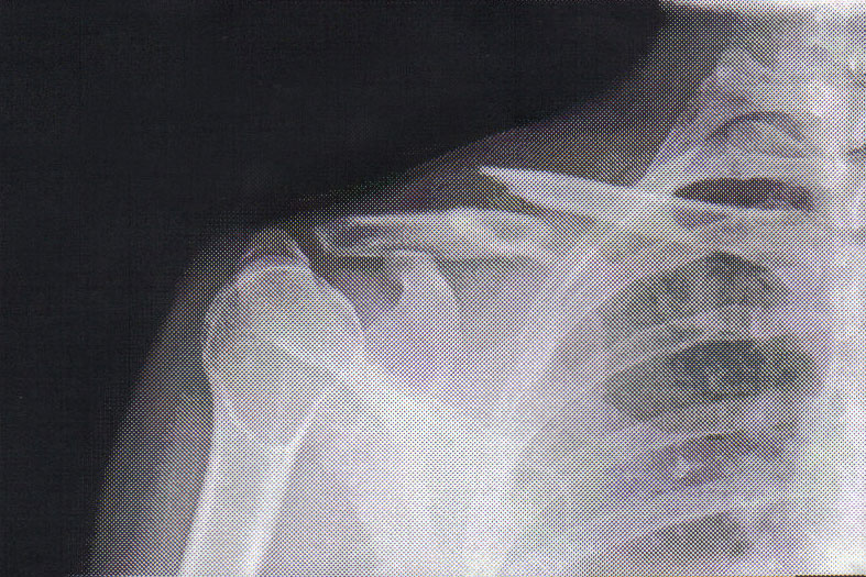 An X-ray of Matt's broken collarbone