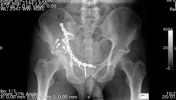 An x-ray of a broken pelvis held together with titanium plates and screws